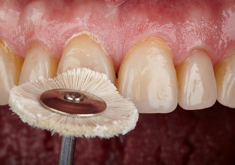 A Predictable Resin Composite Injection Technique, Part 1 Dentistry
