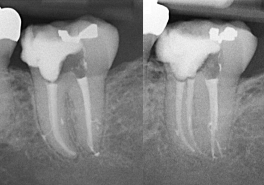 SystemBased Endodontics Does Your GuttaPercha Master Cone Fit