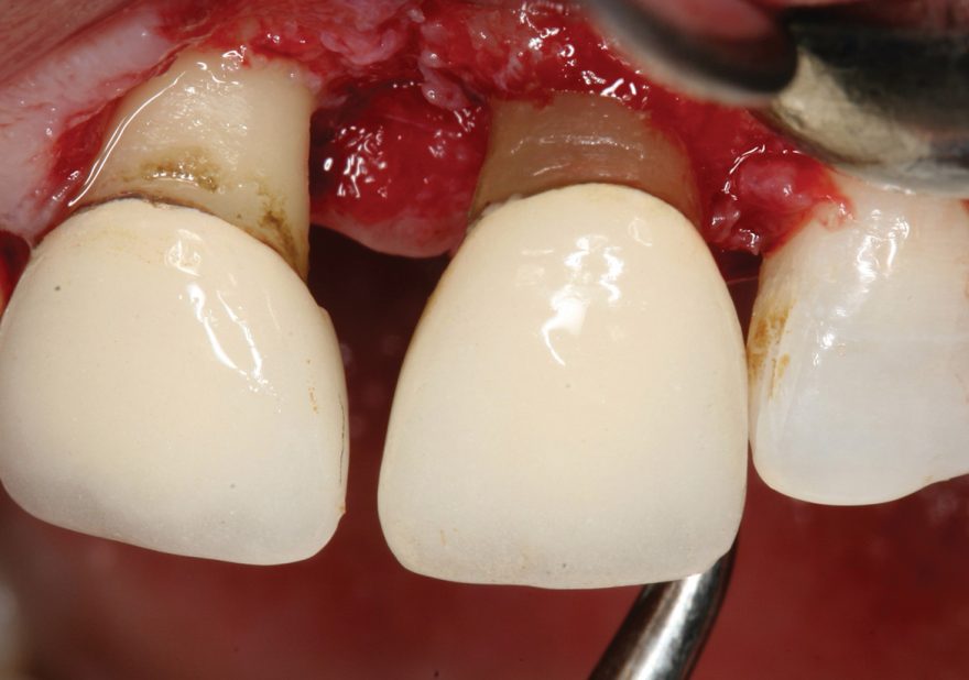 Orthodontic Forced Eruption (175) Dentistry Today CE