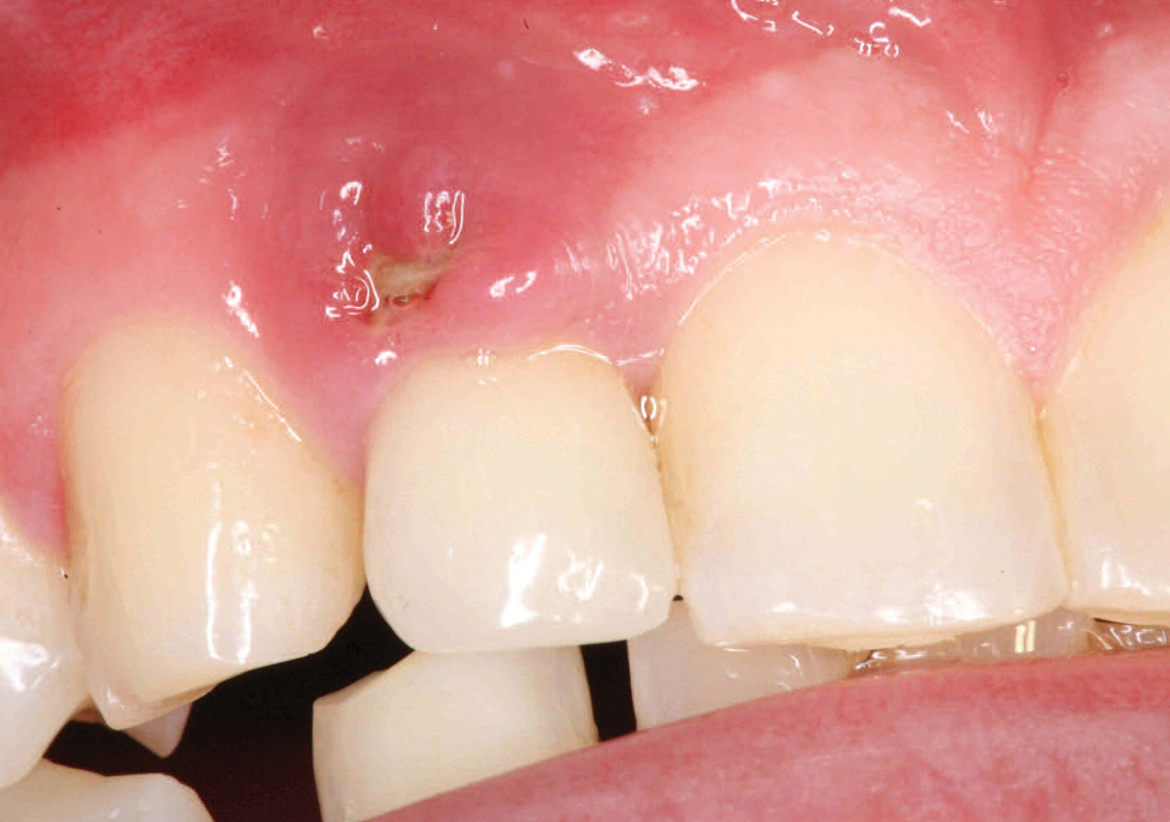 The Role of Cements in Dental Implant Success, Part 1 (160