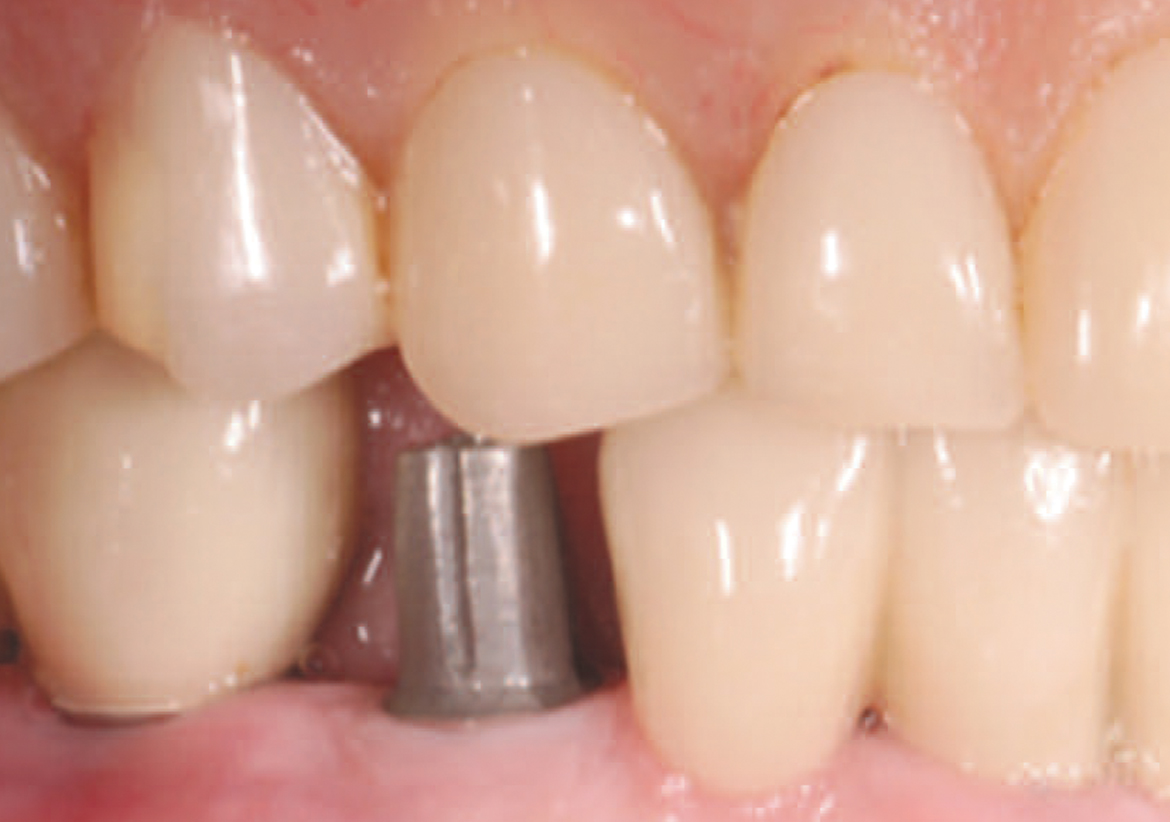 The Role of Cements in Dental Implant Success, Part 2 (162