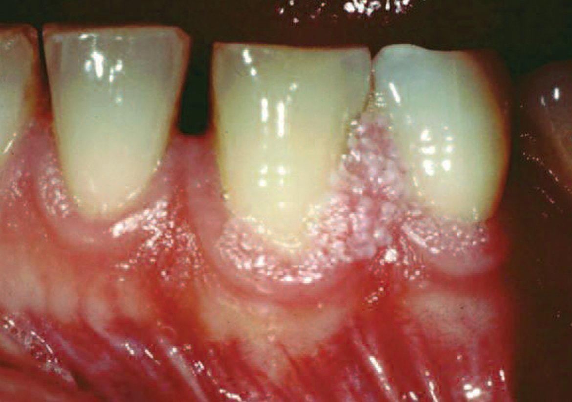 papilloma between teeth)