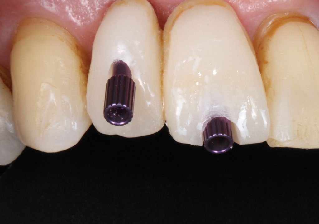 SingleUnit CementRetained Implant Restorations (210) Dentistry