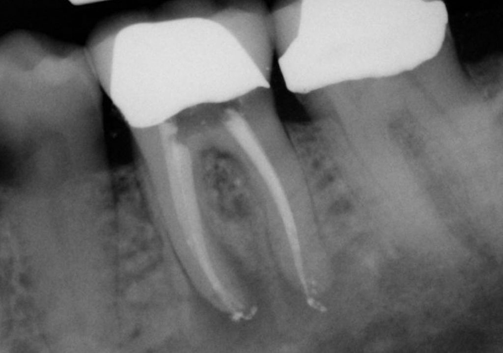 Types of Endodontic Lesions Clinical Considerations (218) Dentistry Today CE