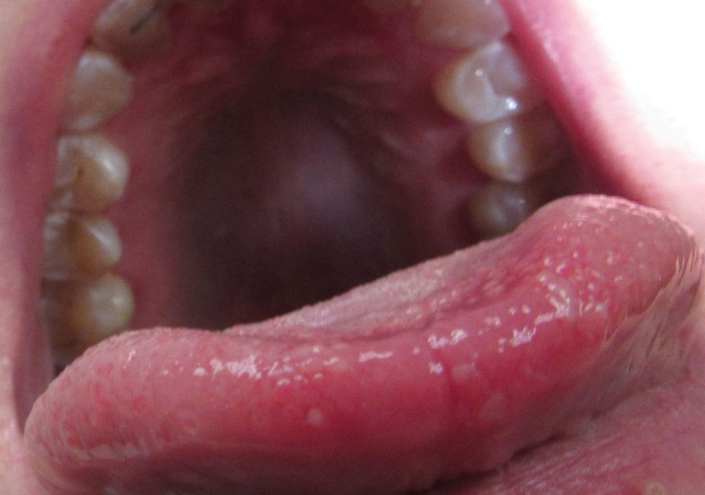 Orthodontic Retainers and Anterior Tongue Hypersensitivity Case