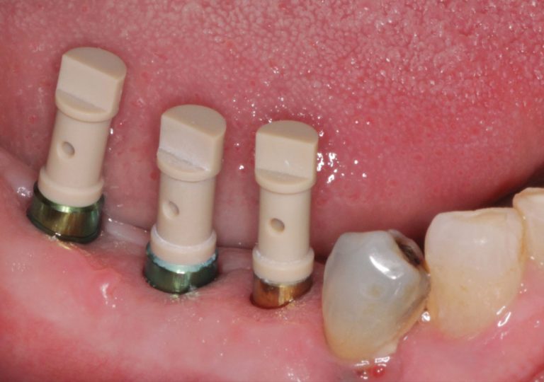 The Complete Digital Workflow in Implant Dentistry (230) Dentistry