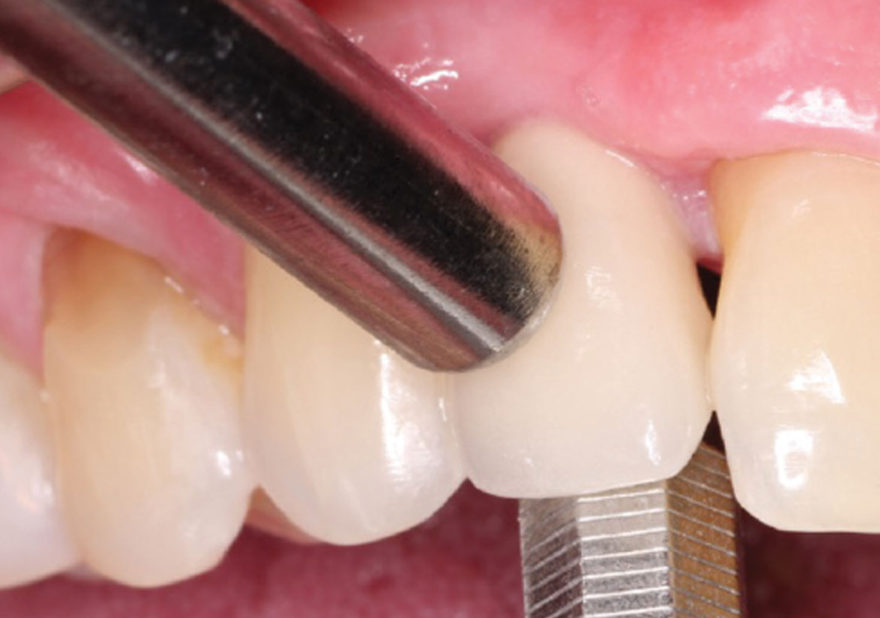 The Dreaded Loose Abutment Screw Etiology, Management, and Prevention